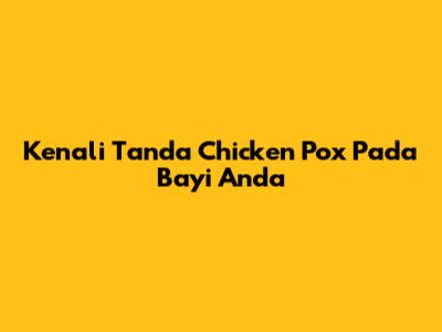 Kenali Tanda Chicken Pox Pada Bayi Anda